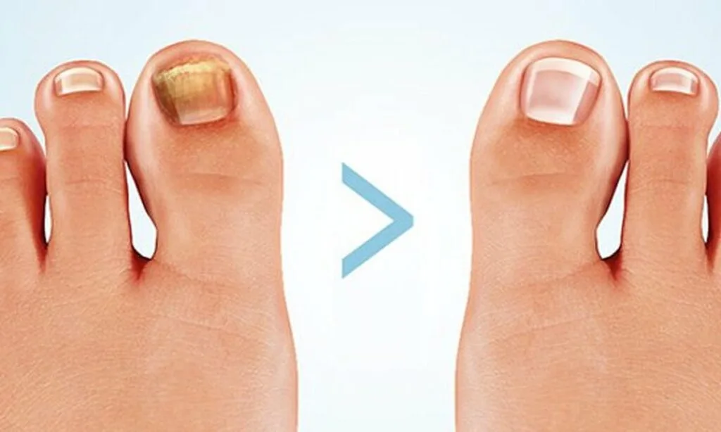 Trattamento delle unghie calve