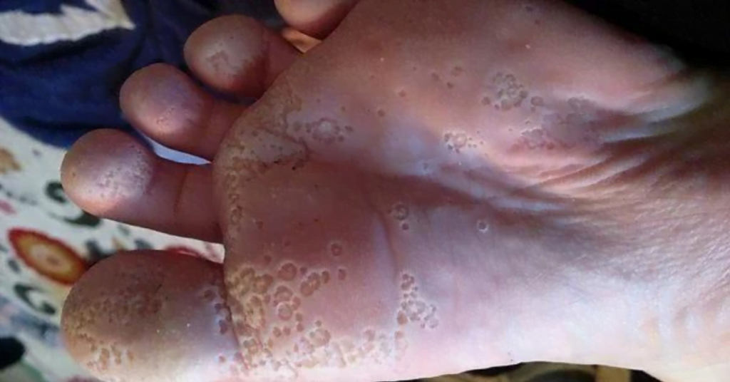 Pianta del piede con pitted keratolysis